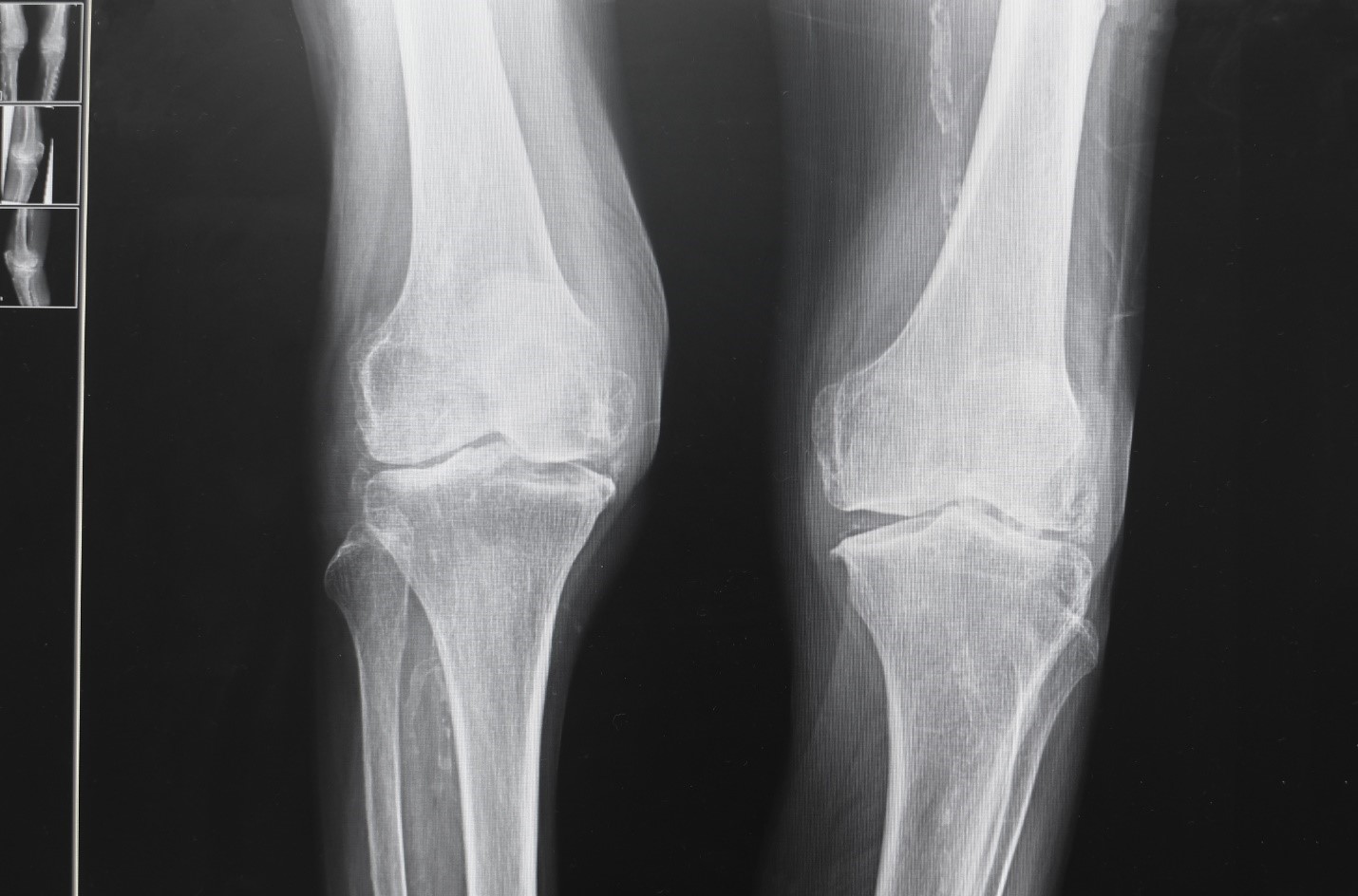 knee xray